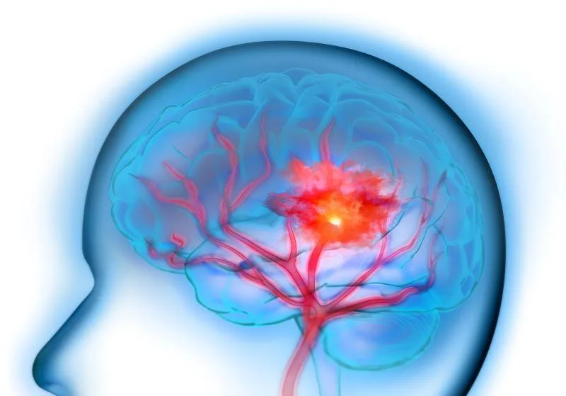 Adding Blood Thinners to ClotBusting Meds Won't Improve Stroke